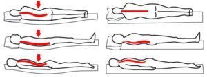 Postura scorretta vs. postura corretta. La prima può essere causata da una rete (foto) o da un materasso cedevole. Fonte: GrzItalia